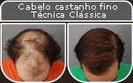 Clique para Ampliar e veja os resultados da cirurgia de implante de cabelo