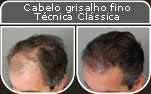 Clique para Ampliar e veja os resultados da cirurgia de implante de cabelo