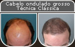 Clique para Ampliar e veja os resultados da cirurgia de implante de cabelo
