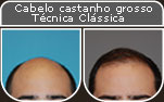 Clique para Ampliar e veja os resultados da cirurgia de implante de cabelo