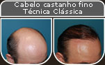 Clique para Ampliar e veja os resultados da cirurgia de implante de cabelo