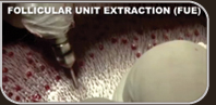 Follicular Unit Extraction - FUE Follicular Unit Extraction - FUE