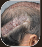 Associação de pequenas sessões de FUE com a técnica clássica (início do desenvolvimento da técnica).