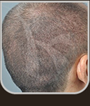 Aspecto da cicatrização completa após 15 dias, permitindo que o paciente use o cabelo com corte à máquina