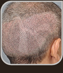 Aspecto no primeiro dia após uma megasessão de F.U.E. Observar as incisões com menos de um milímetro