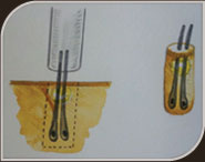 Desenho esquemático da retirada de unidades foliculares pelo método FUE