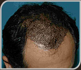 Foto da região capilar no final da semana do implante de cabelo