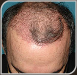 Foto de 1º mês após a Cirurgia de Implante de Cabelo