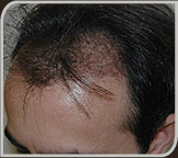 Foto 15 dias após a cirurgia de Implante Capilar