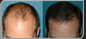 Foto de 6 meses após a Cirurgia de Implante de Cabelo