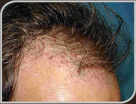 Foto de 2 meses após a Cirurgia de Implante de Cabelo