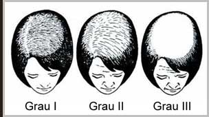 Calvície Feminina - Classificação de Ludwig
