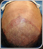 Foto implante da unidade folicular