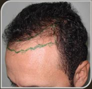 Foto Marcação da linha anterior