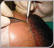 Foto implante da unidade folicular