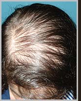 Foto Calvicie Feminina, Queda de Cabelo