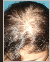Foto - Calvície Feminina tem cura
