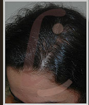 Foto - Calvície Feminina tem cura