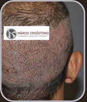 Imagem de uma grande sessão de FUE realizada pelo Dr. Márcio Crisóstomo. Imagem de uma grande sessão de FUE realizada pelo Dr. Márcio Crisóstomo.